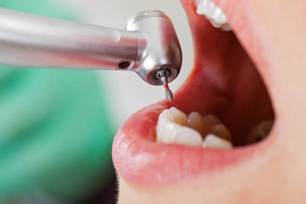 Best Emergency Tooth Extraction in Tappahannock, VA